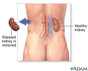 kidney-removal-procedure-picture